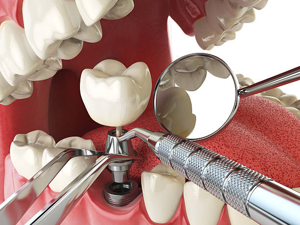 Best Urgent Tooth Repair  in USA